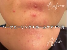 人気NO.1☆痛みなしハーブピーリング繰り返すあごニキビケア◎