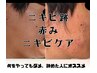 【学割U24】ニキビケア/赤みケアコース100分¥5,000→¥２,500