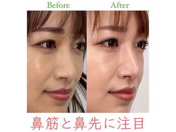 ラプリ 福岡博多店(Raplit)/隆鼻+輪郭・小顔矯正 美鼻/小顔