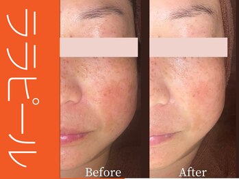 ビューティーリバース 海老名店/ララピール50分