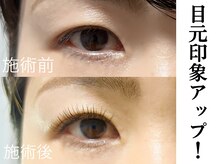 リム(Lim)/瞳に影を作らない！