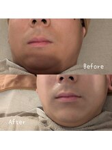 サロン ド モミカル(salon de momikaru)/毛穴洗浄