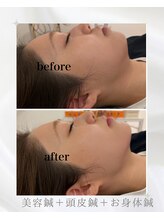 マホロバ(mahoroba)/美容鍼で最強小顔