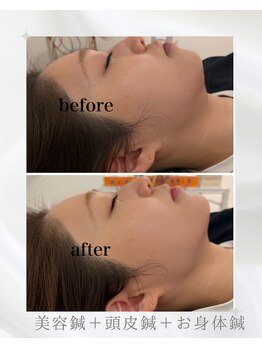 マホロバ(mahoroba)/美容鍼で最強小顔