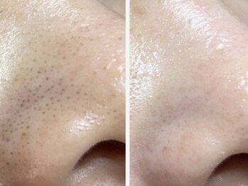 ドゥナ(DUNA)/毛穴洗浄コース