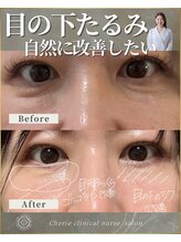 シェリー(Cherie)/【インセルダム】目の下のたるみ