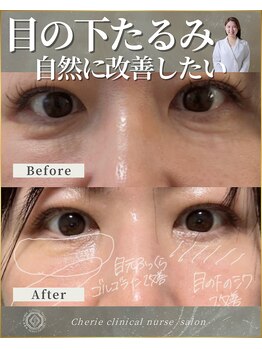 シェリー(Cherie)/【インセルダム】目の下のたるみ