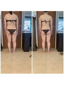 ブランシェ 銀座(blanche)/ブライダルお客様　施術前後