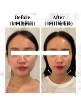 ザビューティー 麻布十番本店(The Beauty)/12Dリフト全顔打ち放題[リフト]