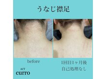 アクト クロ(ACT curro)/【うなじ襟足】脱毛施術例
