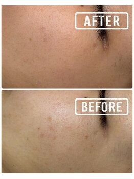 ギャラクシービューティー(galaxy beauty)/プラズマしみケア