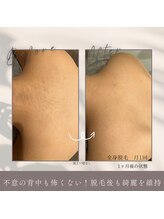 モアトゥインクル 山口店(MORE twinkle)/★症例写真★【20代】