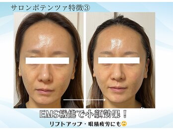 エイミー(Aimee)/EMS搭載でリフトアップ効果も！