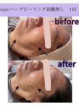 リラ(Lilas)/【epicハーブピーリング】1回目