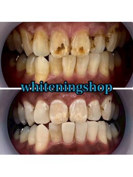 ホワイトニングショップ 武蔵小杉店/【BeforeAfter】11回 施術後比較