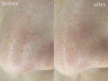 ハリト エステ(HaRi&)/毛穴洗浄/熊本/ハーブピーリング