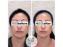 キュープ 相模原淵野辺店(Qpu)/たった4回で人生で1番小さな顔に