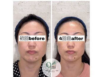 キュープ 相模原淵野辺店(Qpu)/たった4回で人生で1番小さな顔に
