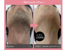 シロ(SHIRO)/メンズ髭脱毛