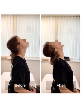 ナオル整体 新宿院(NAORU整体)/20代女性-猫背矯正Before/After