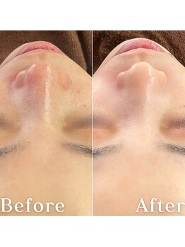 ミニョスキンラボ/韓国式ハーブピーリング3回