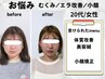 ［初回限定］お顔スッキリコース　美容鍼×小顔矯正★90分体験価格￥6000