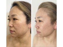 40代　ほうれい線／フェイスラインのたるみ改善／目の開き／