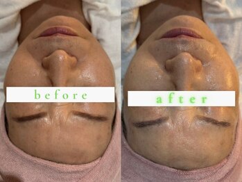 アンベリール(embellir)/タイムロック　1回☆ビフォアフ