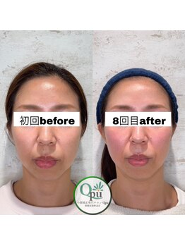 キュープ 相模原淵野辺店(Qpu)/たった4回で人生で1番小さな顔に