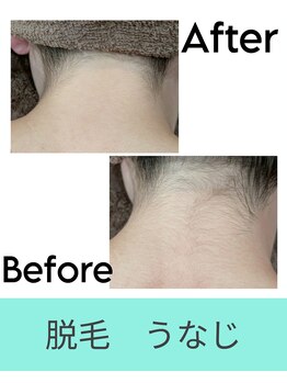 エミナル(EMINAL)/襟足脱毛で後ろ姿美人に! 脱毛