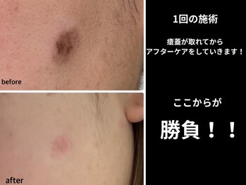 ベリル(BERYL)/魔法のシミとり 施術1回目