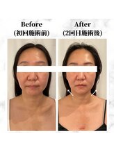 ザビューティー 麻布十番本店(The Beauty)/12Dリフト全顔打ち放題[リフト]