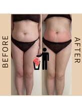 ココノワ(coconoix)/脂肪冷却&キャビテーション