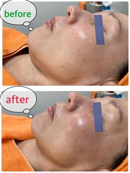 ドマーニプラス 名古屋駅前店(DOMANI PLUS.)/効果５倍の炭酸パック