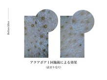 ビーマジック(美magic)/ハイドラフェイシャル症例