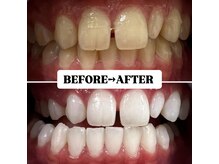 ホワイトニングサロン 豊中/Before&After美白ホワイトニング