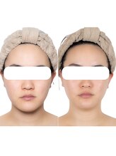 エステティックサロン ドゥネール/【4回の施術】