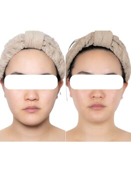 エステティックサロン ドゥネール/【4回の施術】