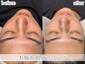 ミック(Mecc)/お悩み別ピーリング60分