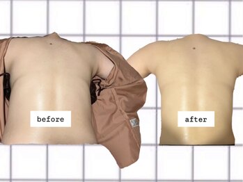 わたしのネイルとよもぎ蒸し/月1のカッピングだけで痩身！