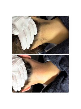 サロンドアメソン(Salon de AMESON)/うなじW脱毛(ワックス+光)