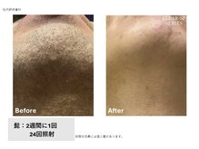 メン脱 三軒茶屋(Men脱)/青ヒゲ改善症例