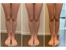 エニ 恵比寿(eni)/脚のビフォーアフター