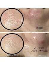 エメ 心斎橋(Aimer)/ハーブピーリングで毛穴がきれい