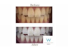 ホワイトニングショップ 島根店/Before&After美白ホワイトニング