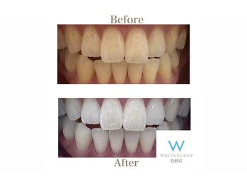 ホワイトニングショップ 島根店/Before&After美白ホワイトニング