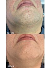 シャイン 熊本店(SHINE)/ヒゲ脱毛無料キャンペーン開催中