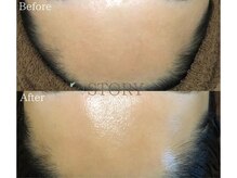 ストーリー 岐阜店(STORY)/ハーブピーリング専門店STORY