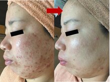 ブリリアン デイスパ 阪急西宮ガーデンズ店(BRILLIAN DAYSPA)/水光ピーリング