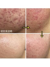 シャイン(shine)/Ｗａｘ＆光フェイシャル